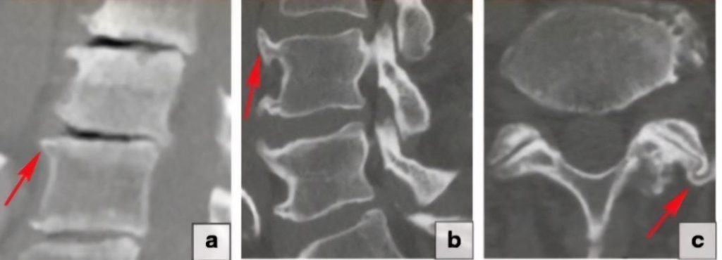 osteofitos, osteopatia, artrosis,procesos degenerativos